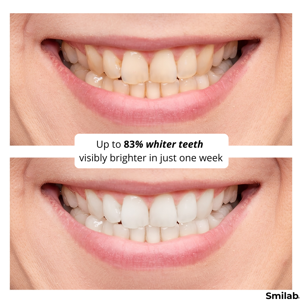 Teeth Whitening Strips