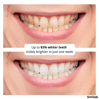 Teeth Whitening Strips